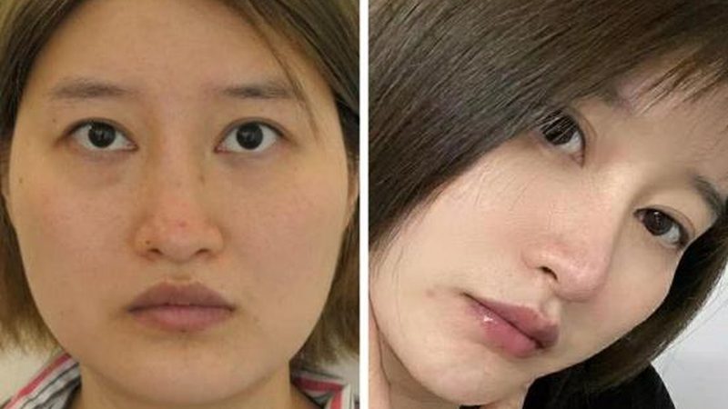 注射美容不适合哪些人