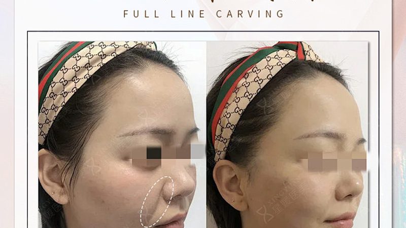 小标题：选择全切双眼皮手术医院的关注要点