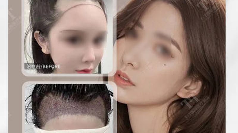 热玛吉治疗头哪个规格效果好