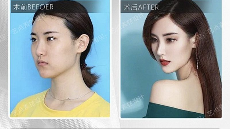 小型激光脱毛机：揭秘其优缺点与选购要点