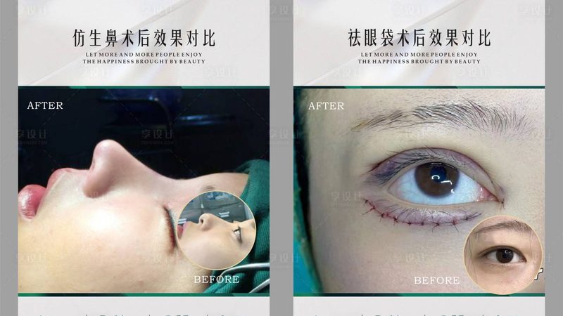 注射隆鼻和手术隆鼻的区别