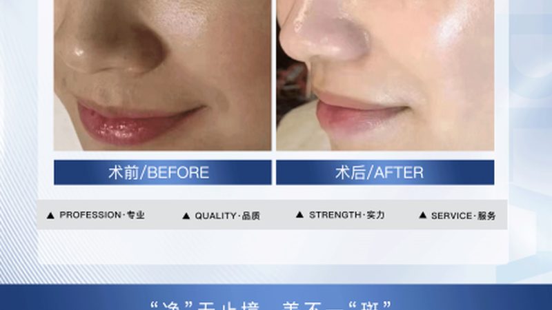 隆鼻术后护理方法