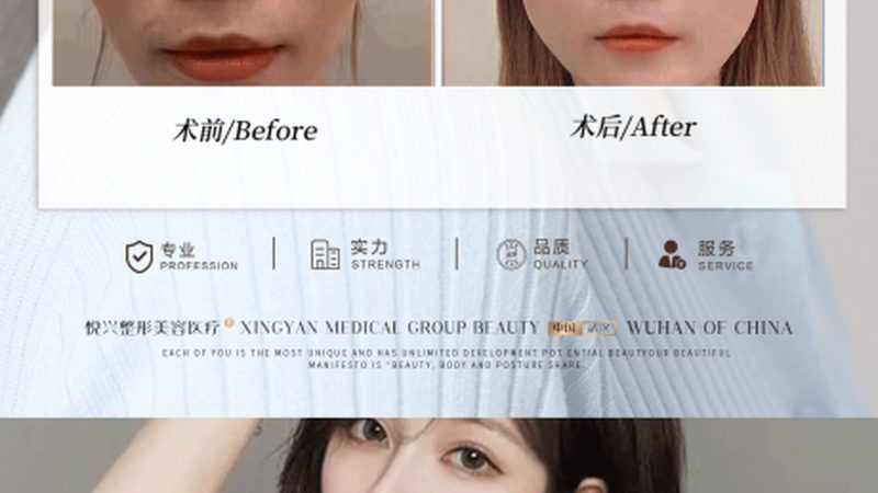 光子嫩肤去红血丝：揭秘原理与效果