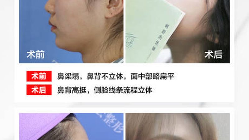 北京瘦脸针，揭秘价格背后的真相