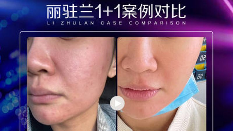 水光针术后化妆时间揭秘：保养与美丽并行