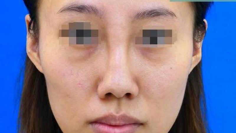热玛吉与线雕：探寻医美抗衰的两种方式